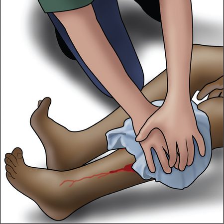 Image for Stop the Bleed Aims to Save Lives